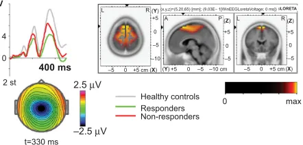 Figure 1 The independent component cue P3 is decreased in non-responders (non-res). Notes: left the independent component for the group of res (green) and non-res (red) in comparison with the group of healthy controls (grey)