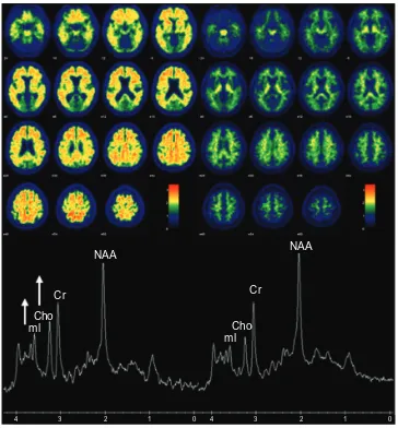 Figure 1 Association between MRS metabolite ratios and cortical Pittsburgh compound-B (PiB) retention ratio on PET.Notes: The left panel shows the PiB retention ratio PET images in an 82-year-old man with a PiB retention ratio of 2.42, NAA/Cr ratio of 1.51