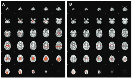 Figure 2 Average of functional magnetic resonance imaging (fMRI) scans from nine subjects before (A) and after (B) radioelectric asymmetric conveyer neuro-postural optimization (REAC-NPO).