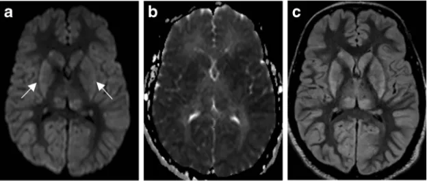 Fig. 1 Hypoxic ischaemic encephalopathy. Sixty-eight-year-old manwith prolonged cardiac arrest presenting with fixed and dilated pupils.DWI (a) demonstrates symmetric increased signal within the deep greymatter (arrows) and cerebral cortex