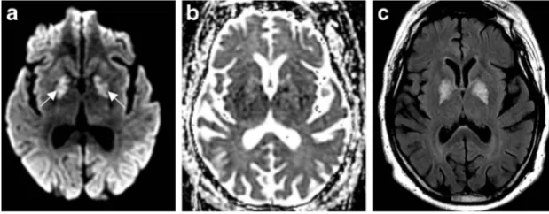 Fig. 2 Hypoglycemia. Thirty-four-year-old man with altered mentalstatus. DWI (a) demonstrates symmetric increased signal within thebasal ganglia (arrows) and cerebral cortex, notably the insular andparietal cortex