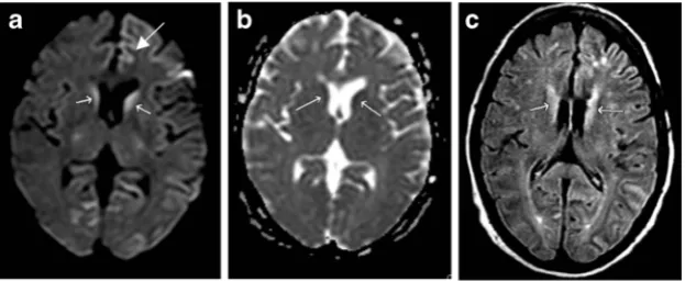 Fig. 4 Venous infarct. Forty-three-year-old woman with headache andincreased somnolence