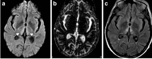 Fig. 6 Status epilepticus. Forty-eight-year-old woman with seizures andaltered mental status