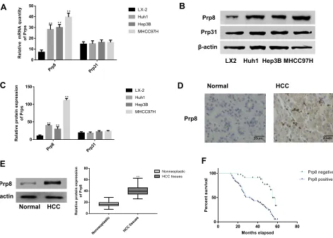 Figure 1 The expression of Prp8 is increased in HCC cells and tissues. (A) Prp8 mRNA expression in HCC cells compared with hepatic astrocytes