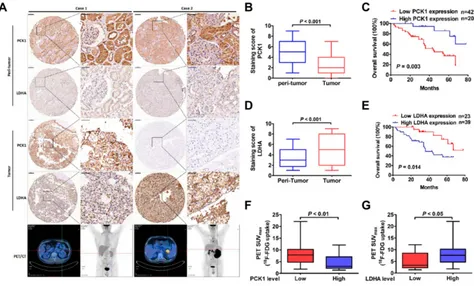 Figure 4 The relationship between PCK1 and tumor prognosis, LDHA and glucose uptake in patients with ccRCC.left ccRCC with high PCK1 expression.The mean PCK1 immunohistochemical staining scores in ccRCC tissues and normal peritumoral tissues