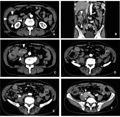 Figure 1 CT ﬁndings with contrast medium injection. (A) The circumferential wall thickness in the ascending colon (arrowheads) and swollen lymph nodes is shown