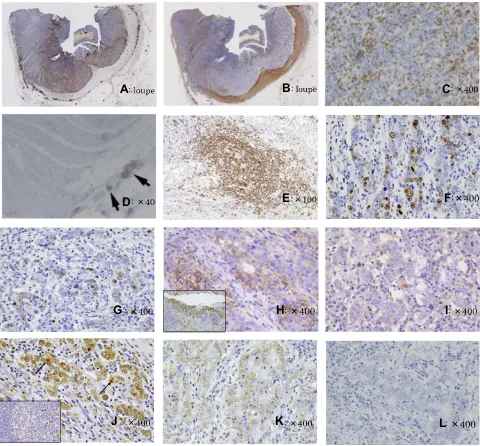 Figure 6 Findings of immunohistochemical staining and in situ hybridization. (DNA (ssDNA) overexpression was observed in the lymphocyte-rich component (control using the tissue of the germinal center of the lymph follicle (×100)