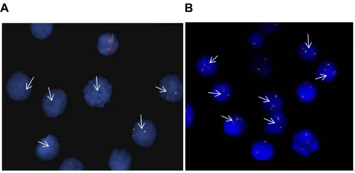 Figure 1 FISH detection of the two cell lines of MLL-rearranged acute leukemia. Arrow: positive signal cells (one red, one green, and one fusion signal), (A) THP-1 cells, (B)RS4:11 cells.