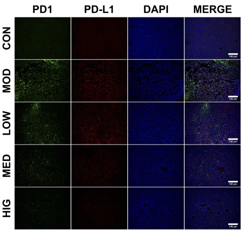 Figure 2 Immunoﬂuorescence staining of PD1 and PD-L1 in tumor cells. PD1 is shown in green; PD-L1 is shown in red; and DAPI represents the cell nuclei