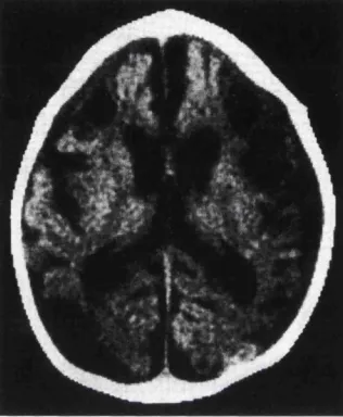 Figure 3-4 Computed tomography scan performed at 4 months of age after hypoxic- four months after the injury occurred