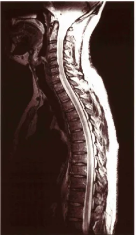 Figure 2.9: Spinal cord image using the phased array coil (fast spin echo).