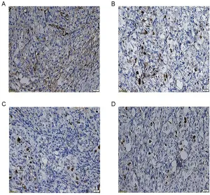 Figure 8 Immunohistochemistry staining of P53 (40×10). Control group (the difference of the expression level of P53 was no statistically signiA)