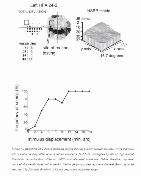 Figure 7.2 Humphrey 24-2 from a glaucoma subject showing inferior arcuate scotoma. Arrow indicates site of motion testing within area of normal Humphrey 24-2 field, overlapped by site of High SpatialResolution Perimetry (box)