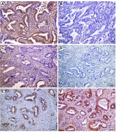 Figure 1 Immunohistochemical expression of FOXP1 in extrahepatic cholangiocarcinoma (EHCC), peritumoral tissues, adenoma, and normal tissues