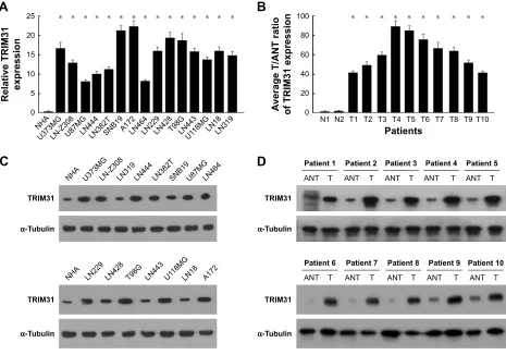 Figure 1 TriM31 is upregulated in glioma cells and tissues.Notes: (A) TRIM31 was significantly upregulated in glioma cells compared to primary normal human astrocyte (NHA) determined by qPCR