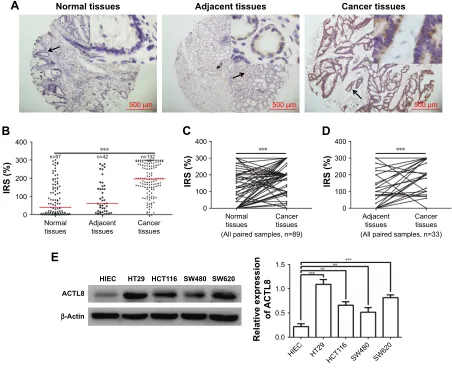 Figure 1 acTl8 protein was upregulated in crc.Notes: (A) representative micrographs showing immunohistochemical staining of acTl8 in normal colorectal tissue, tumor-adjacent tissue, and crc tissue