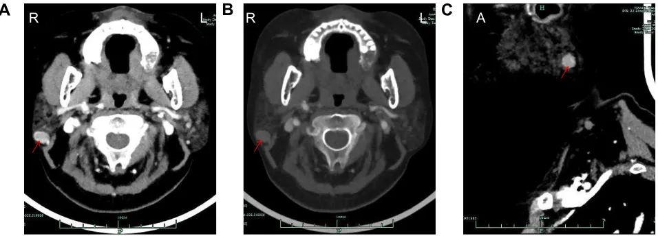 Figure 2 Images of the whole-body PeT/CT scan 2 weeks post-surgical excision showing a nodule (red arrow) (0.3*0.8 cm) in the post-operative site with maxsUV values of 1.7 (A)