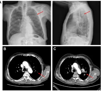 Figure 4 Posttreatment chest images. Notes: Chest X-ray (A) and CT (B) 2 months after sBrT revealed a greatly regressed small nodule (red arrows)