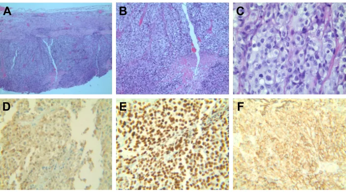 Figure 1 representative section of gallbladder mass biopsy.Notes: H&E stained sections of gallbladder mass biopsy show sheets of neoplastic cell infiltration with focal necrosis (A and B, 4× and 10×, respectively)