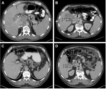 Figure 2 Computed tomography images of abdomen before and after treatment.Notes: (A and B) Before treatment: there was extensive intraabdominal lymphadenopathy including right retrocrural lymph node (white arrow in A), and periportal and peripancreatic lym