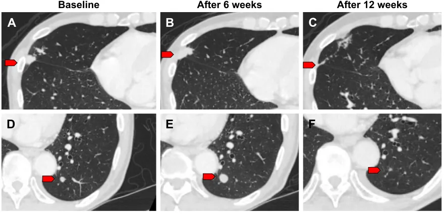 Figure 1 CT imaging of pseudo-progression.Notes: (A, D) Representative CT imaging before nivolumab treatment