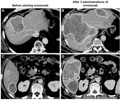 Figure 2 CT imaging of hyper-progression.Notes: (A, C) Representative CT imaging before nivolumab treatment