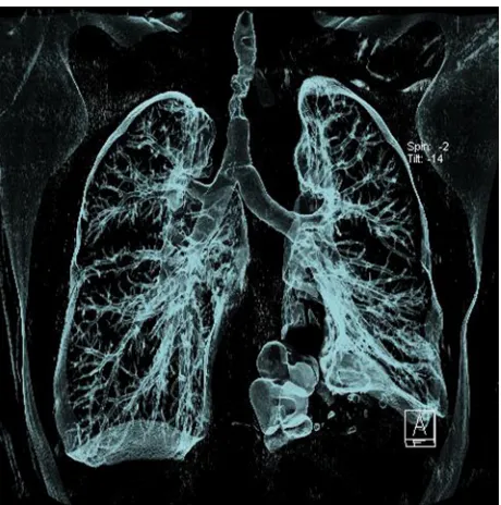 Figure 1 Three-dimensional imaging of the airway showing significant stenosis in the middle of the trachea and atelectasis in the lower left part of the lung.