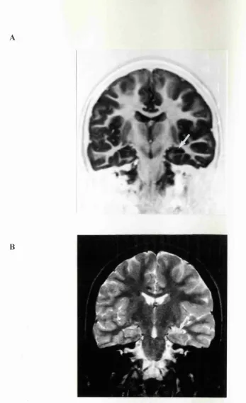 Figure 3.4: Tilted coronal slices through the hippocampus of patient T1 showing 