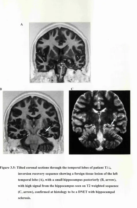 Figure 3.5: Tilted coronal sections through the temporal lobes of patient T3â,