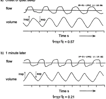 Figure 4.1.2: Variability of breathing pattern in a term neonate