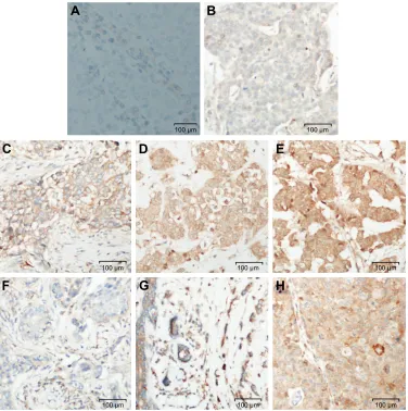 Figure 3 aPc and axin immunohistochemical staining in breast carcinomas.Notes: (A) negative control (no primary antibody); (B) negative; (C) weak; (D) moderate; (E) strong; (F) negative; (G) weak; (H) moderate