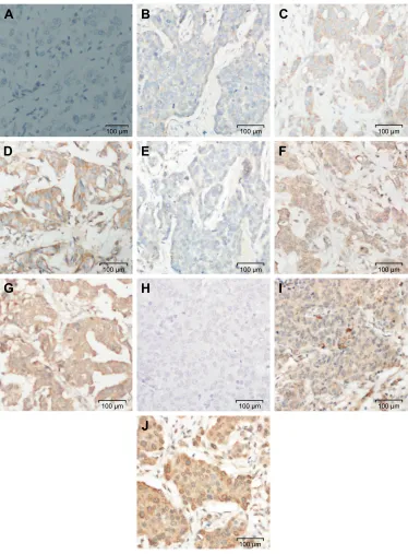 Figure 4 immunostaining of negative regulators of Wnt pathway in breast carcinomas.Notes: (A) negative control (no primary antibody); Panels (B–D) represent DKK3, (B) negative, (C) weak, (D) moderate