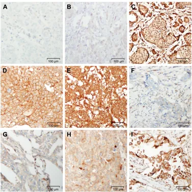 Figure 5 c-Myc and cyclin D1 immunostaining in breast carcinomas.Notes: (A) negative control (no primary antibody); (B) negative; (C) weak; (D) moderate; (E) strong; (F) negative; (G) weak; (H) moderate; (I) strong
