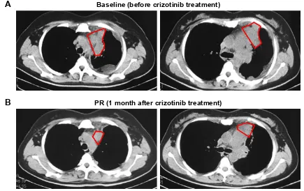 Figure 1 responses of a CD74–ROS1 fusion patient with pulmonary blastoma to crizotinib.Notes: Computed tomography scans of the chest were obtained at baseline and after 1 month of treatment with crizotinib