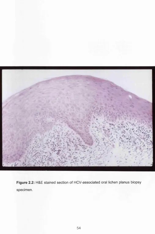 Figure 2.2: H&E stained section of HCV-associated oral lichen planus biopsy 