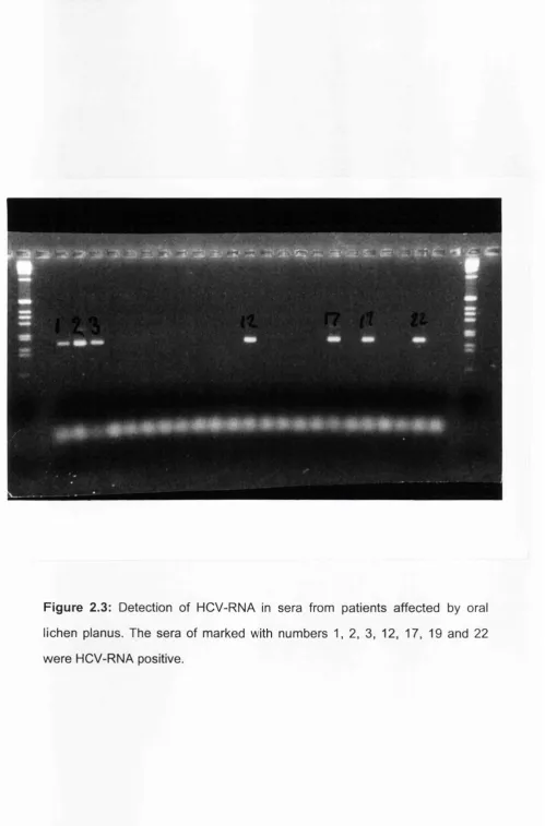 Figure 2.3: Detection of HCV-RNA in sera from patients affected by oral 