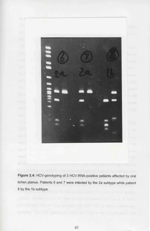 Figure 2.4: HCV-genotyping of 3 HCV-RNA-positive patients affected by oral 
