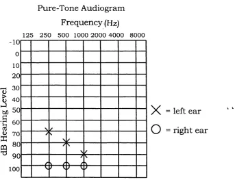 Figure 1.1: Audiogram example