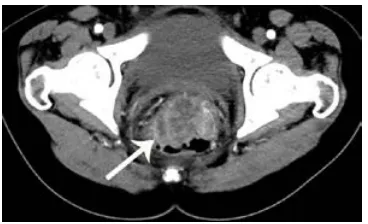 Figure 3 computed tomography scan of 29-year-old woman with signet-ring cell carcinoma of the rectum.Notes: contrast-enhanced computed tomography scan shows concentric rectal wall thickening with target sign