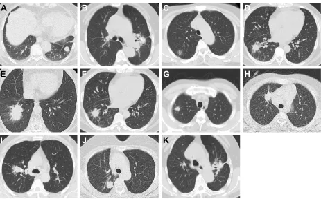 Figure 1 The computed tomography morphological features of patients with stage i non-small cell lung cancer.Notes: (A) The lesion in the right lower lobe showed homogeneous density and smooth and regular margins