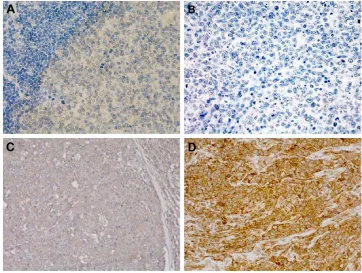 Figure 1 expression of PiK3ca was evaluated using ihc in both DlBcl and rh tissues.Notes: (A) Weak positive immunostaining of PiK3ca in cells dispersed in and out of the germinal center of rh lymph node