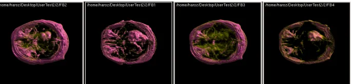 Fig. 7. These images show a time-variant dataset in which a tumor can be seen growing and shrinking inside a brain