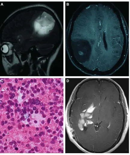 Figure 1 Pre- and postoperative Mri and histopathological diagnosis for patient 1.Notes: (A and B) Preoperative T2-weighted sagittal and T1 contrast-enhanced axial images showed a space occupying lesion with T2 heterogeneous hyperintensity and central dott