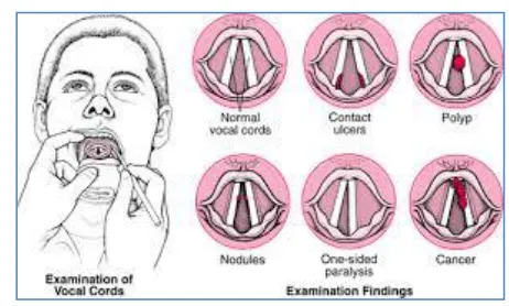 Fig. 1:  Examination of Vocal Cords to find the Pathology  