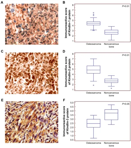 Figure 2 subcellular localizations and expression patterns of Kindlin proteins in human osteosarcoma tissues.Notes: The positive Kindlin-1 (A) Kindlin-2 (C) and Kindlin-3 (E) protein immunostainings were localized in the cytoplasm, nucleus and cytoplasm, r
