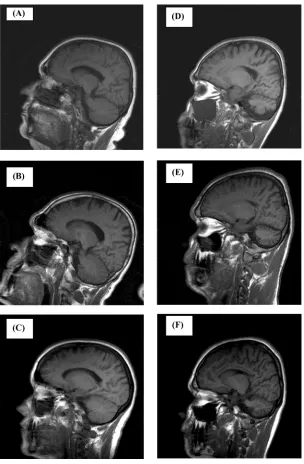Figure 2. Sagittal brain scans to visualize the cerebellum from mother (A), father (B), unaffecteddaughter (C), affected daughter (D), affected son (E), and another affected daughter (E).