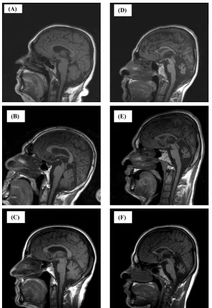 Figure 3. Midsagittal MRI scans to visualize the cerebellar vermis, cerebrum, and corpus callosumfrom mother (A), father (B), unaffected sister (C), affected daughter (D), affected son (E), andanother affected daughter (F).
