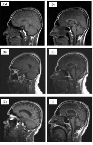 Figure 4. Sagittal MRI scans from a control subject (A, D), the quadrupedal man (B, E), and thebipedal-ataxic man (C, F) from the second family