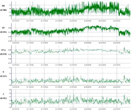 Figure 5. Non-steady-state and non-linear analysis of QT dynamics performed in healthysubject, using Neilson’s method