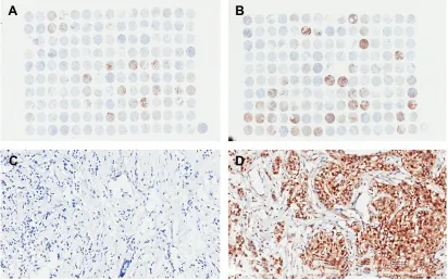 Figure 1 Tissue microarray and immunohistochemistry staining of P-cofilin in invasive ductal breast cancer tumors.Notes: (A) Tissue microarray 1 (150 cases), 1× magnification; (B) tissue microarray 2 (150 cases), 1× magnification; (C) negative expression of P-cofilin, 200× magnification; and D) positive expression of P-cofilin, 200× magnification.Abbreviation: P-cofilin, phosphorylated cofilin.